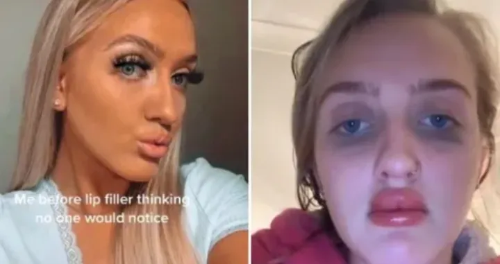 Povećanje usana po&scaron;lo po zlu: Sreća pa je korona i mora&scaron; nositi masku