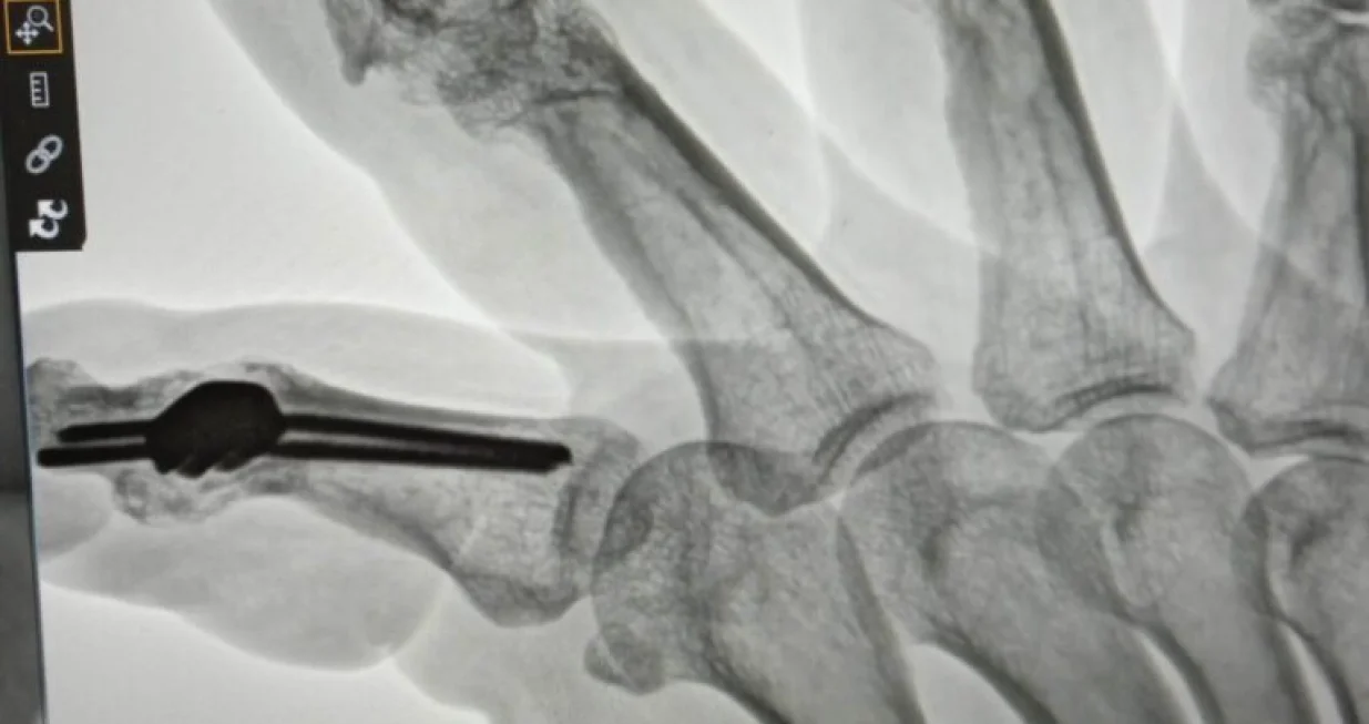 Andreju Slokaru, veteranu Odreda policije 'Bosna' i prvoborcu Domovinsko-oslobodilačkog rata u BiH, već 30 godina se niko ne odaziva na vapaje u pomoć/