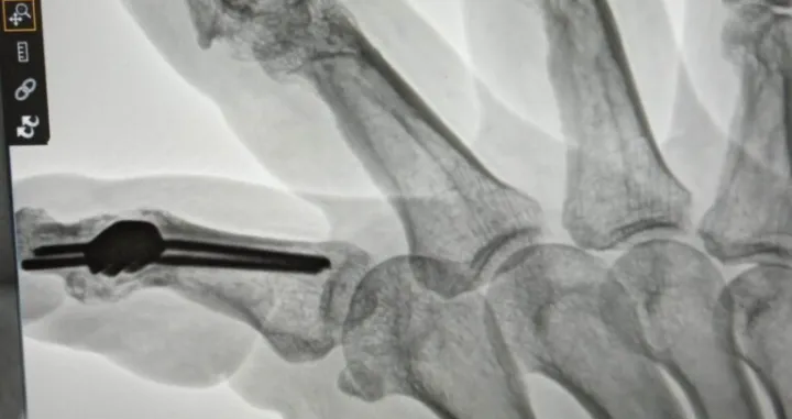 Andreju Slokaru, veteranu Odreda policije 'Bosna' i prvoborcu Domovinsko-oslobodilačkog rata u BiH, već 30 godina se niko ne odaziva na vapaje u pomoć/