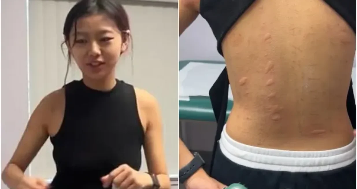 TikTokerica iz Seula ima brojne alergije/