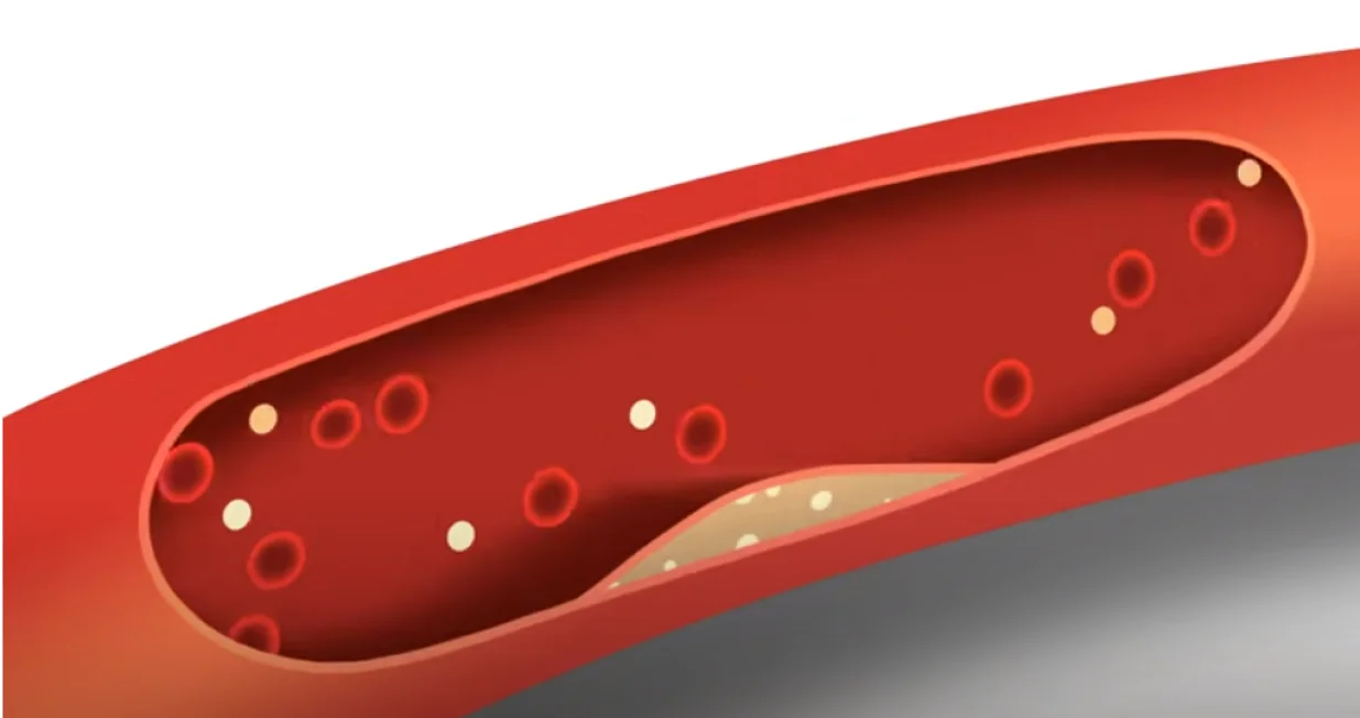 Razvijena vakcina protiv jednog od vodećih uzroka kardiovaskularne bolesti/ Screenshot/ Youtube/