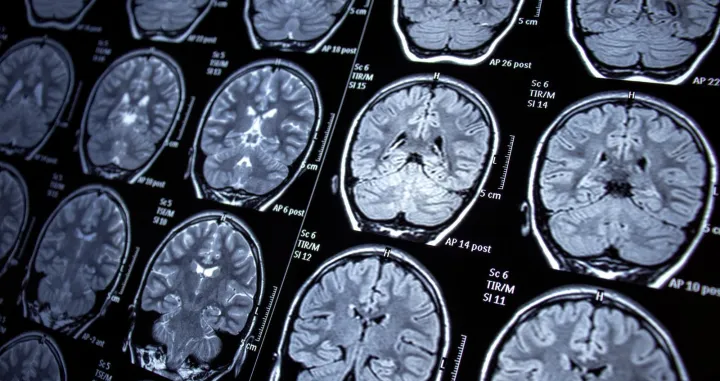 mri mozak/
