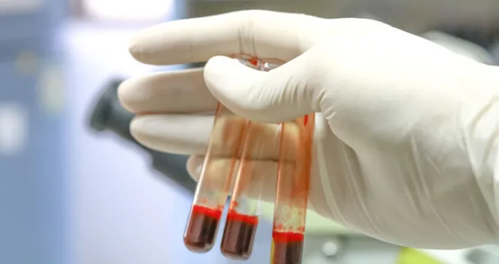 multipla skleroza test/