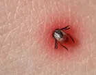 / krpelji/