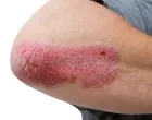 psorijaza ljeto/
