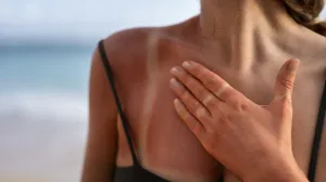 Spas za kožu nakon sunčanja/Free Pik