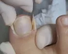 Naučite prepoznati prve simptome/Pinterest
