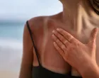 Spas za kožu nakon sunčanja/Free Pik