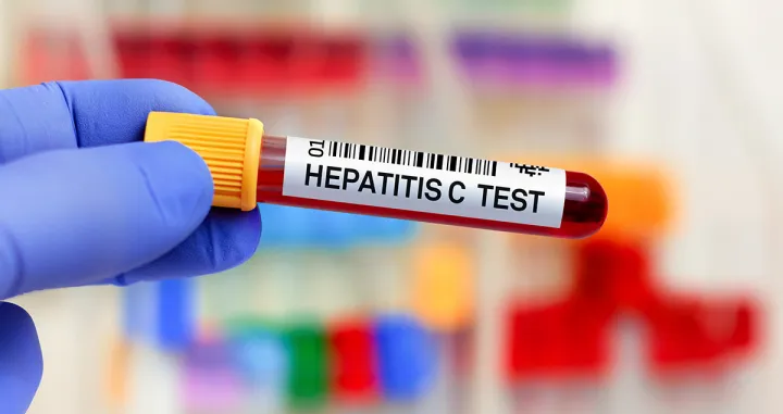 Test na hepatitis C//