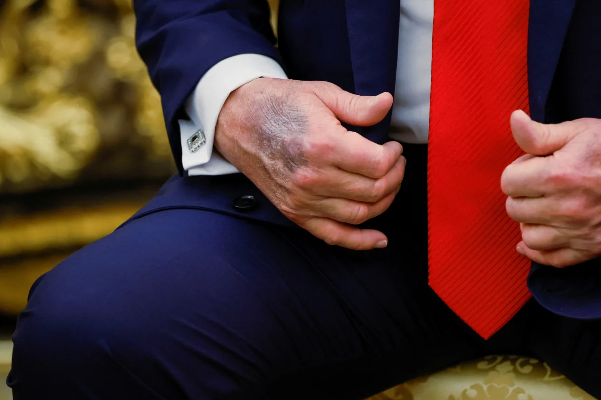 Modrica na Trumpovoj ruci zabrinula javnost/Brian Snyder