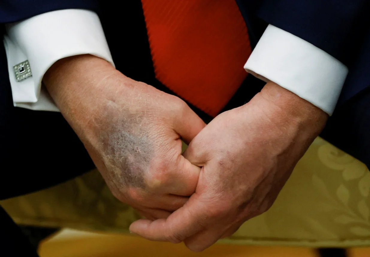 Trump je pokušavao prikriti modricu/Brian Snyder