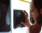 karcinom, rak, rendgen, x-ray, doktor/National Cancer Institute