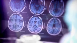 analiza alzheimerove bolesti/Digicomphoto