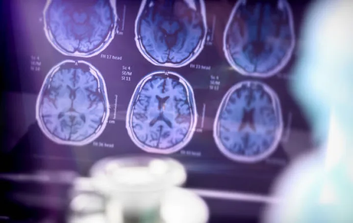 analiza alzheimerove bolesti/Digicomphoto