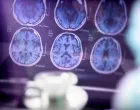 analiza alzheimerove bolesti/Digicomphoto