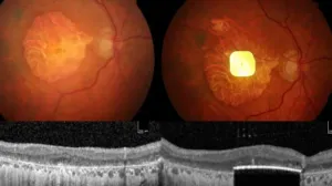 Testiran sićušni čip koji vraća vid, rezultati su odlični/