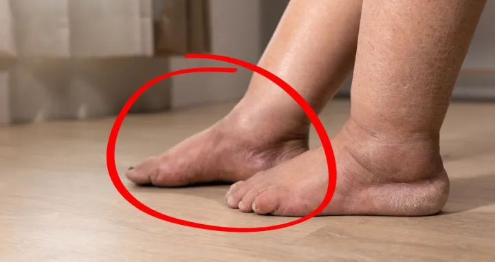 Oticanje nogu je jedan od simptoma bolesti jetre/ Ilustracija/