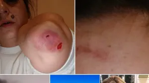 đemila talić gabriel objavila fotografije pretučene kćerke Facebook/Facebook