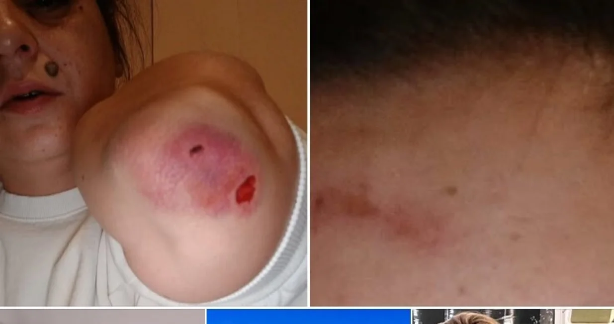 đemila talić gabriel objavila fotografije pretučene kćerke Facebook/Facebook