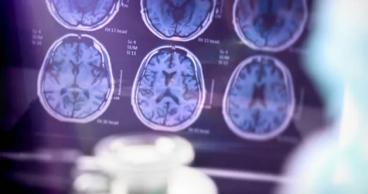 analiza alzheimerove bolesti/Digicomphoto