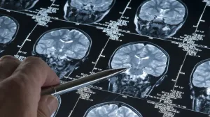 ct mozak, promjene/Ilustracija/- 