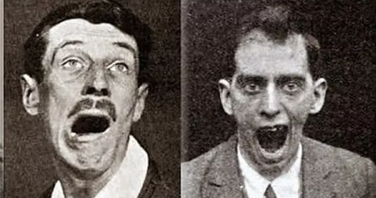 Pacijenti s encefalitisom lethargicom.Izvor fotografije: Medicalcortex putem Wikimedia Commons (CC BY 4.0)/