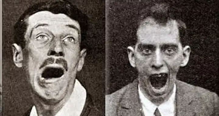 Pacijenti s encefalitisom lethargicom.Izvor fotografije: Medicalcortex putem Wikimedia Commons (CC BY 4.0)/