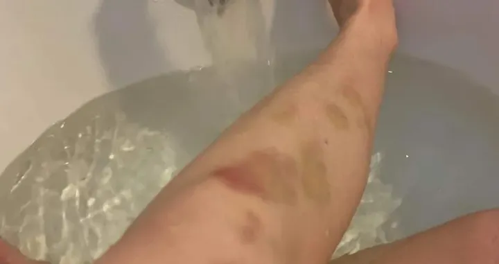 Modrice po nogama nakon brutalnog napada/