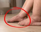 Oticanje nogu je jedan od simptoma bolesti jetre/ Ilustracija/